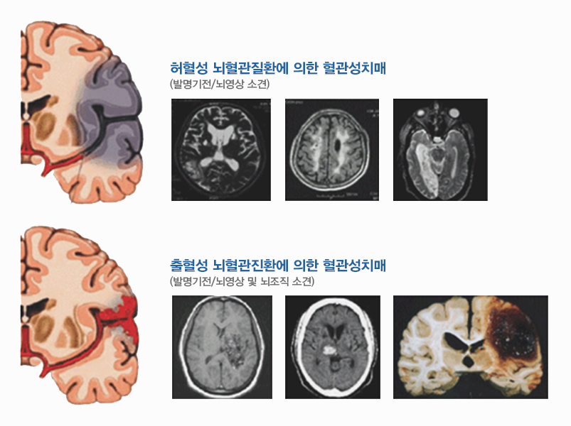 그림 - 허혈성 및 출혈성 뇌혈관질환에 의한 혈관성 치매